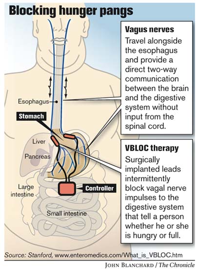 Stanford in study on vagal nerve blocking, gastric bypass surgery 